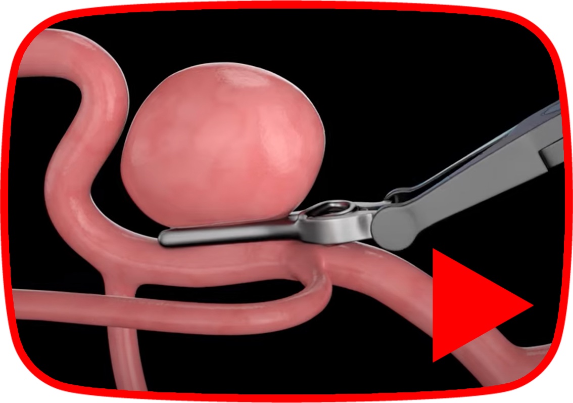 Brain Aneurysm Clips, Appliers & Cranial Closure Peter Lazic Delta